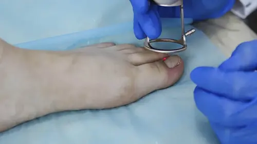 remoção da unha encravada