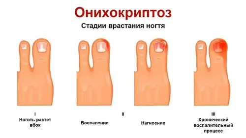 Onicocriptose fases de crescimento das unhas